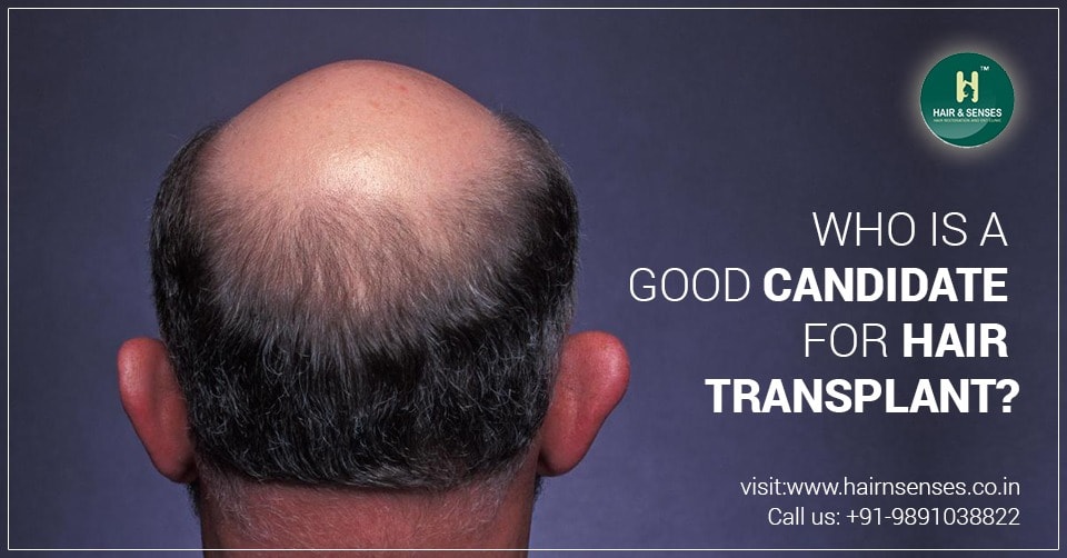 Candidate for Hair Transplant