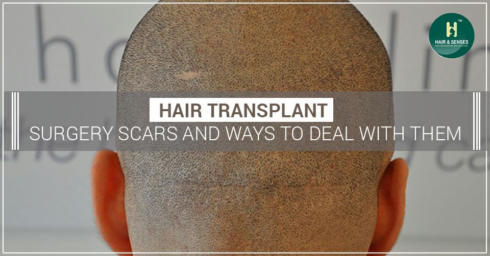 Hair Transplant Scars