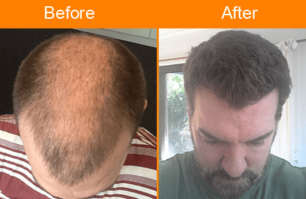 Hair Transplant in India | Hair Transplant Cost in India