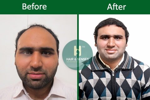 Hair Transplant